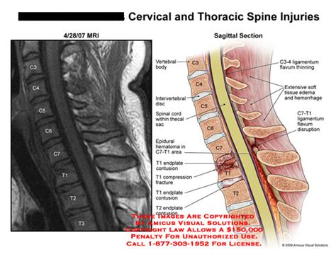 Cervical and Thoracic Spine Injuries