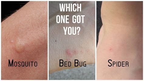 Mosquito, Bed Bug, Spider Bite Differences | Bed bug bites, Bed bugs ...