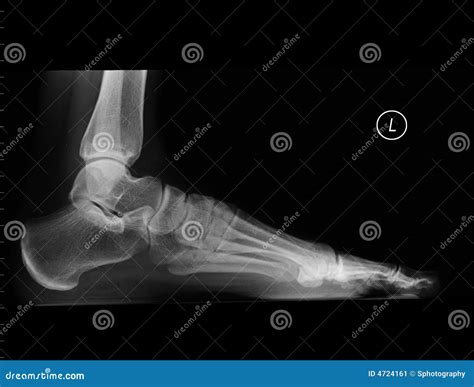 Left Foot X-Ray Stock Image - Image: 4724161