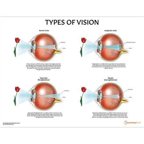 Types of Vision Chart | Eye Poster Anatomical | Anatomy Stuff