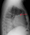 Pleural effusion - Wikipedia