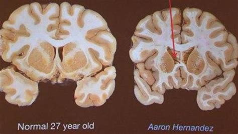 Aaron Hernandez's brain was severely damaged by disease, researcher says - CBS News