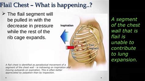 Blunt Chest Trauma - EMS Lecture 10/15 - YouTube