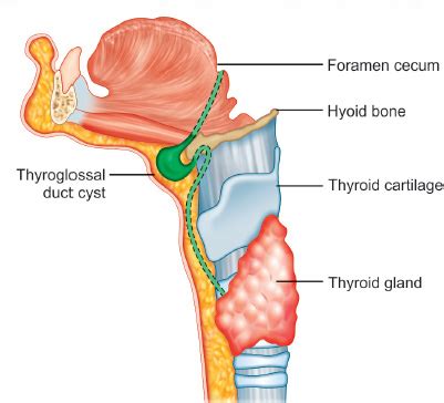 Thyroglossal Duct Cyst Anatomy