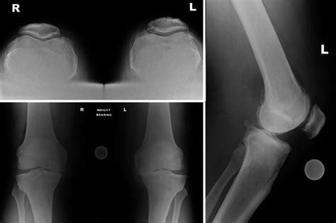 Fig. 28.6, [Bilateral knee osteoarthritis primarily affecting...]. - Personalized Hip and Knee ...