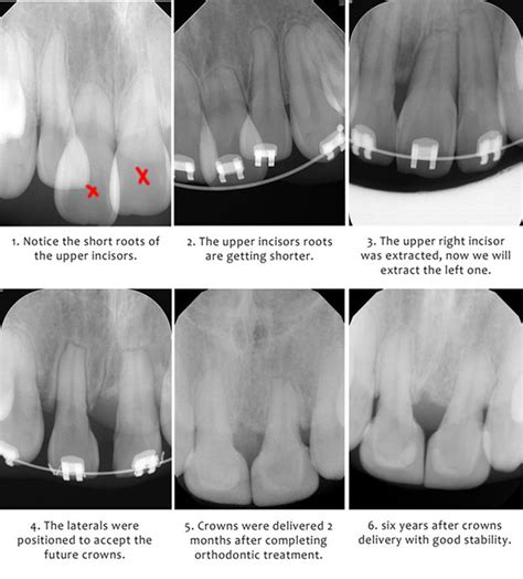 Extreme orthodontic case: non typical upper central incisors extraction pattern | Orthodontist ...