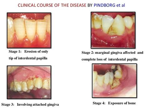 Acute Necrotizing Periodontal Disease - Captions Trending Update