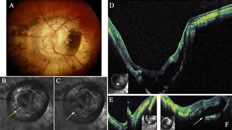 A, Contractile morning glory syndrome (CMGS) of the right eye. B, C,... | Download Scientific ...