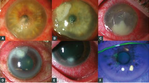 RACGP - Management of microbial keratitis in general practice