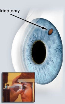 Laser Iridotomy - Pittsburgh, PA & Pittsburgh, PA - North Hills Eye ...