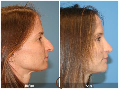 Irvine Deviated Septum | Orange County Nose Surgery