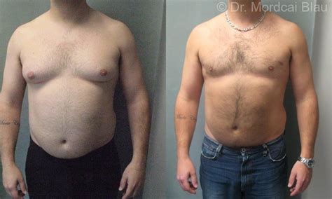 Pseudogynecomastia - Before and After Photos ⋆ Gynecomastia USA