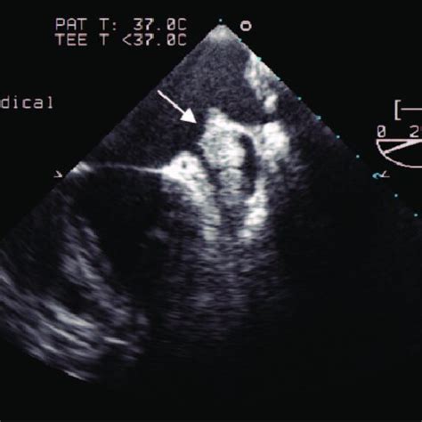 Transesophageal echocardiography showing large left atrial appendage ...