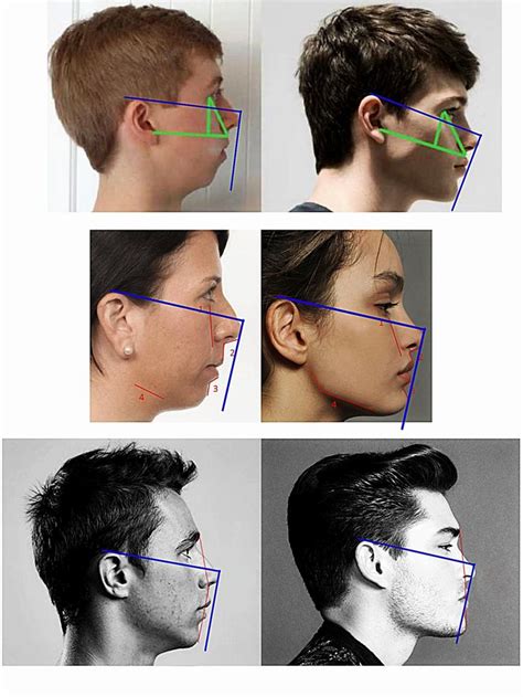 A good way to measure forward facial growth. ((The blue lines. Sorry for quality ...