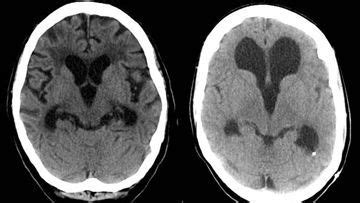 Severe Hydrocephalus Mri