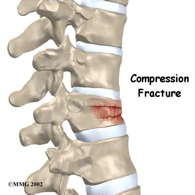 anatomy and physiology: Types of Fractures