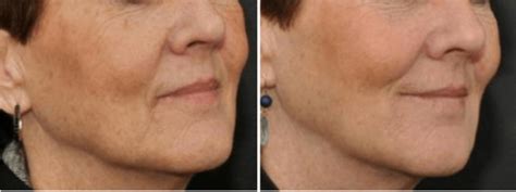 How Can I Reduce the Appearance of Wrinkles Around My Mouth? | Boston ...