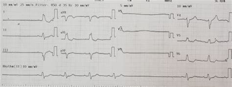 Sick Sinus Syndrome Ekg