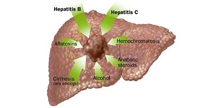 Liver Pain : Location , Causes , Symptoms And Treatment