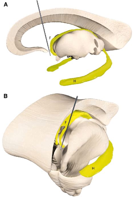 Simplified illustration of anatomical targeting for fornix deep brain ...