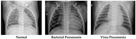 Chest xray normal vs abnormal - pinoybasta