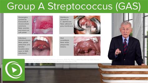 Group A Streptococcus (GAS) – Infectious Diseases | Lecturio