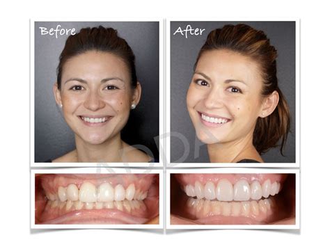 Smile Makeover Case Study 6 - Leanda Before and After | ADDA