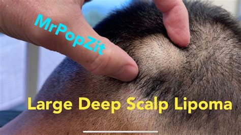 Deep(skull)Scalp Lipoma excision with horizontal mattress stitch ...