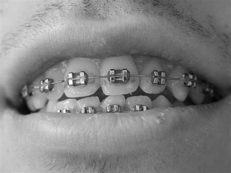 Invisalign vs. Other Forms of Braces – Part 1 | Oaks Dental Korea