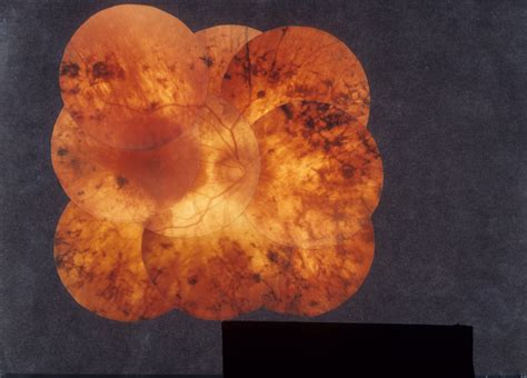 Retinitis Pigmentosa, AD | Hereditary Ocular Diseases