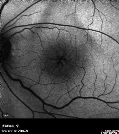 Cystoid Macular Edema (Autofluorescence) - Retina Image Bank