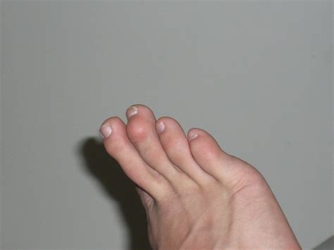 Hammer toe - Wikipedia