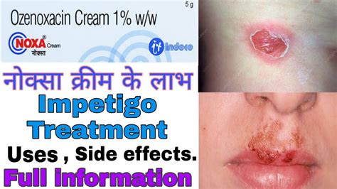 Noxa cream 1% use in hindi || Ozenoxacin 1% uses , Side effects || Best impetigo cream. - YouTube