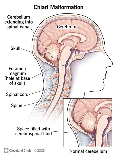 Chiari Malformation: What It Is, Symptoms, Types Treatment, 52% OFF