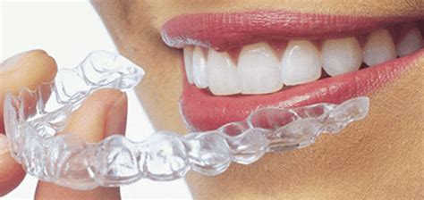 Aligners - Mega Dental Care | Braces | ImplantsCrowns - Fixed | Root ...