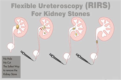 RIRS (Retrograde Intra-Renal Surgery) Using Flexible Scopes – MKM Hospital