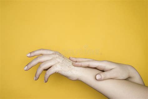 Hands with Dry Cracked Skin, the Concept of Hand Skin Problems. Yellow ...