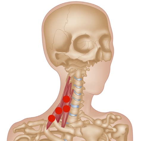 Scalene Muscles Trigger Points