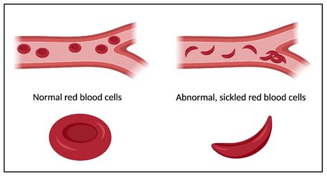 Gene therapy for sickle cell disease shows promise – HudsonAlpha Institute for Biotechnology