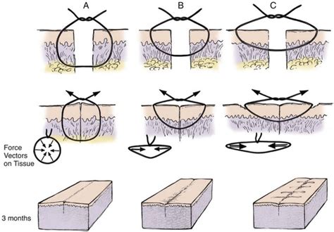 4: Wound Closure Techniques | Pocket Dentistry