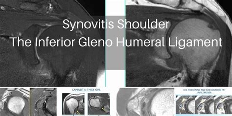 MRI SYNOVITIS SPECIFIC SITES IN THE SHOULDER: THE INFERIOR GLENOHUMERAL LIGAMENT IGHL - Radedasia