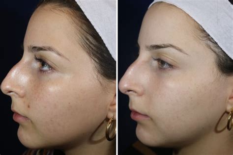 What To Expect When You Laser Away Your Acne Scars | Into The Gloss