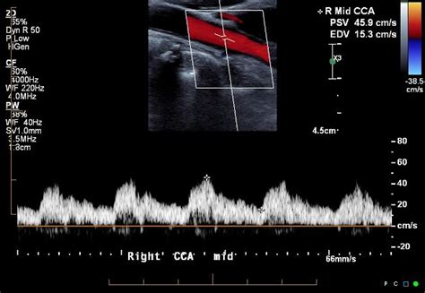 Brachiocephalic trunk stenosis | Image | Radiopaedia.org