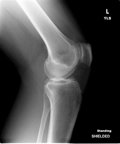 Rheumatoid Arthritis X Ray