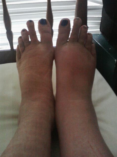 Lymphedema Treatment