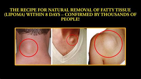 Lipoma Muscle Tissue Fatty Cyst Lipoma Removal | Images and Photos finder