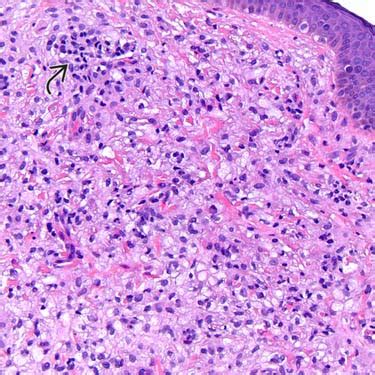 Xanthoma Histology