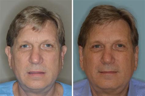 Otoplasty Photos | Miami, FL | Patient 1375