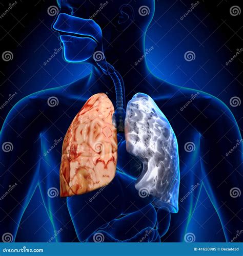 Smoker Vs Non-smoker - Lungs Anatomy Stock Illustration - Illustration ...