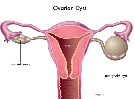 What are ovarian cysts and their treatment options? – drmanavitamahajan